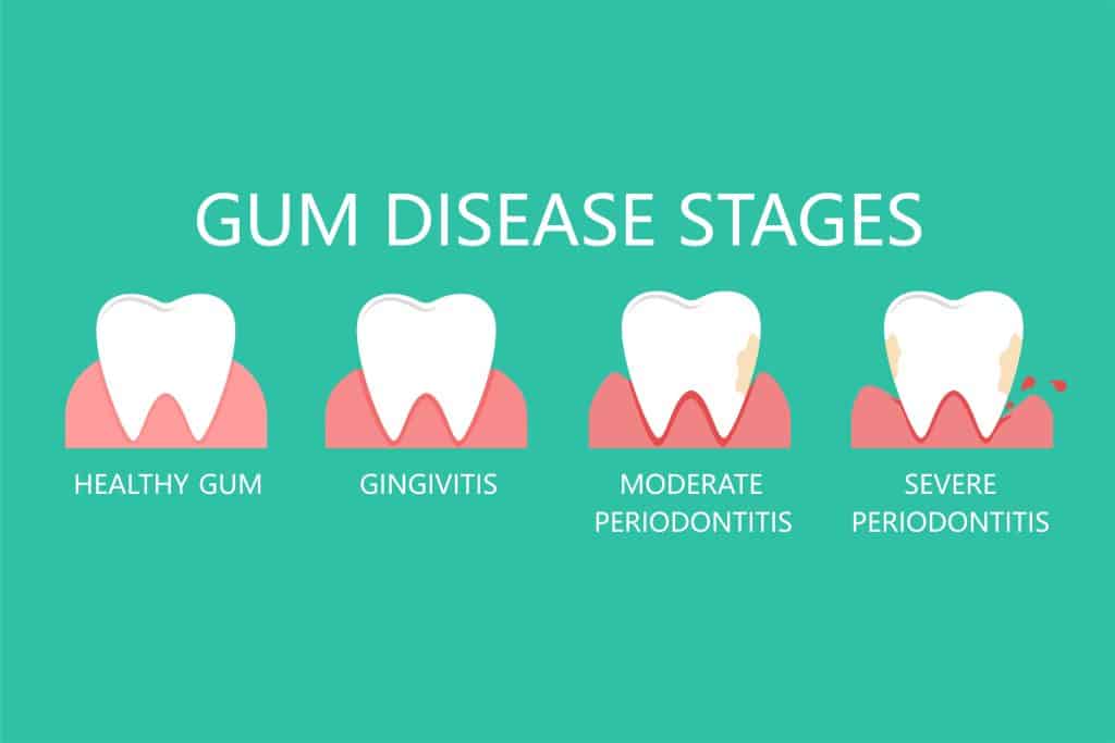 Stages of gum disease Washington Periodontics affordable dental implants, all-on-4 dental implant procedure, patient education, bone grafting, soft tissue grafting, computer guided dental implant surgery, dental implant disease, dental implants, facial cosmetics, facial trauma, frenectomy, full-mouth rehabilitation, implant-supported dentures, language assisted services, receding gums, sedation dentistry, special dental implants, teledentistry, teledentistry implants, tooth extractions, gum grafting, gingivectomy, sinus augmentation, emergency periodontics, cracked tooth repair, oral surgery, periodontics, periodontist Dr. Christine Karapetian Periodontist in Washington, Implants, Periodontics, Gum and Bone Grafting and more in Burke, VA 22015. 703-576-5002